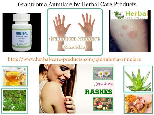 Common Vitamins and Supplements for Treating Granuloma Annulare - Natural Health News