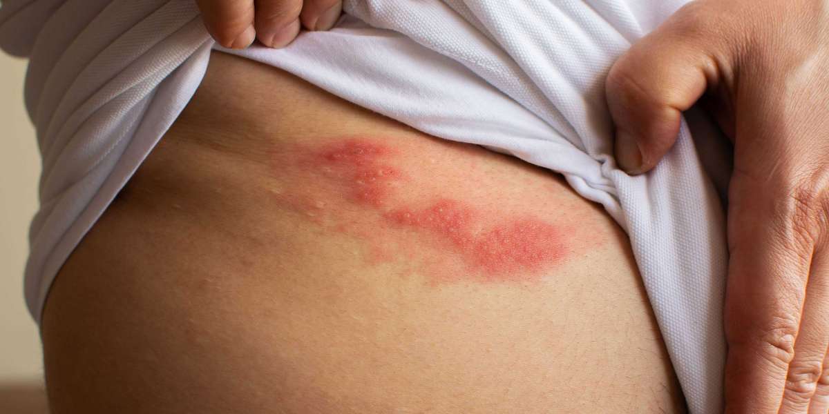 What are a shingles symptom, rash and treatments?
