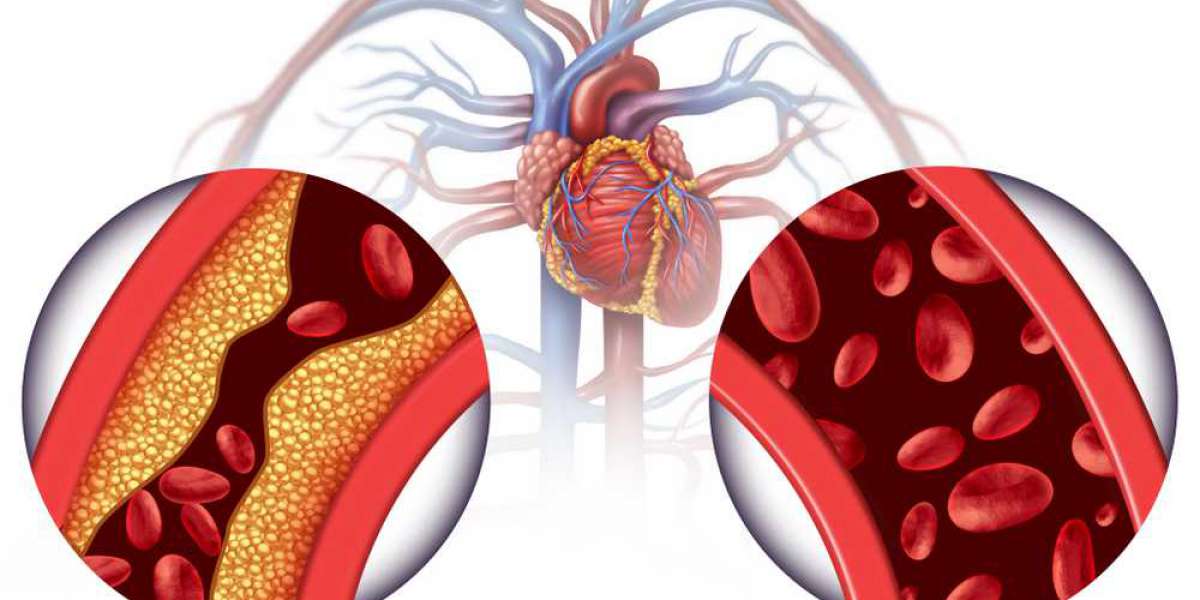 Blood pressure and cholesterol: Why symptom-free does not always mean problem-free?