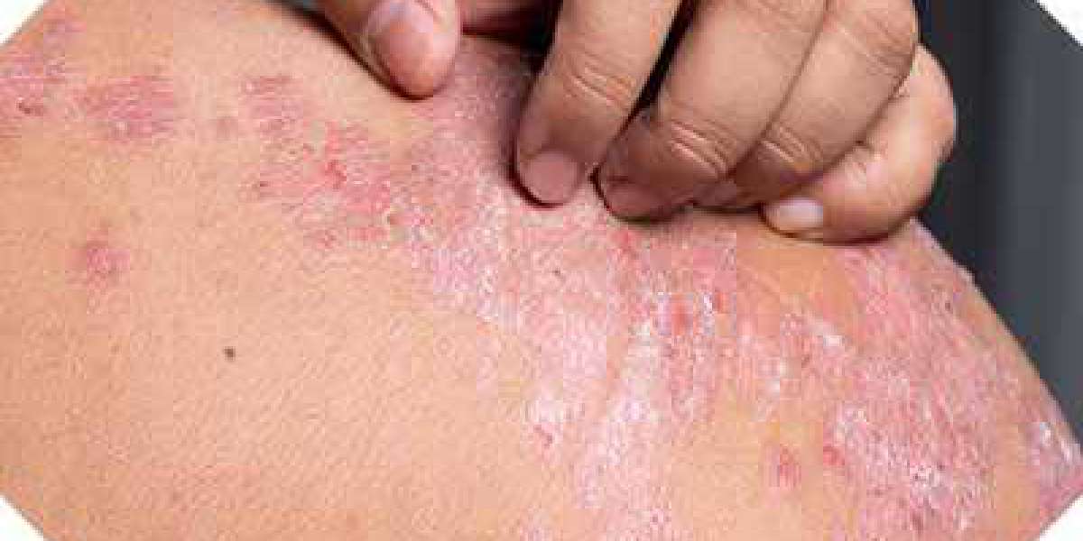 Best homeopathic treatment for psoriasis