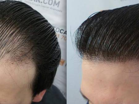 Hair Transplant in Turkey:Costs & best clinics in Istanbul