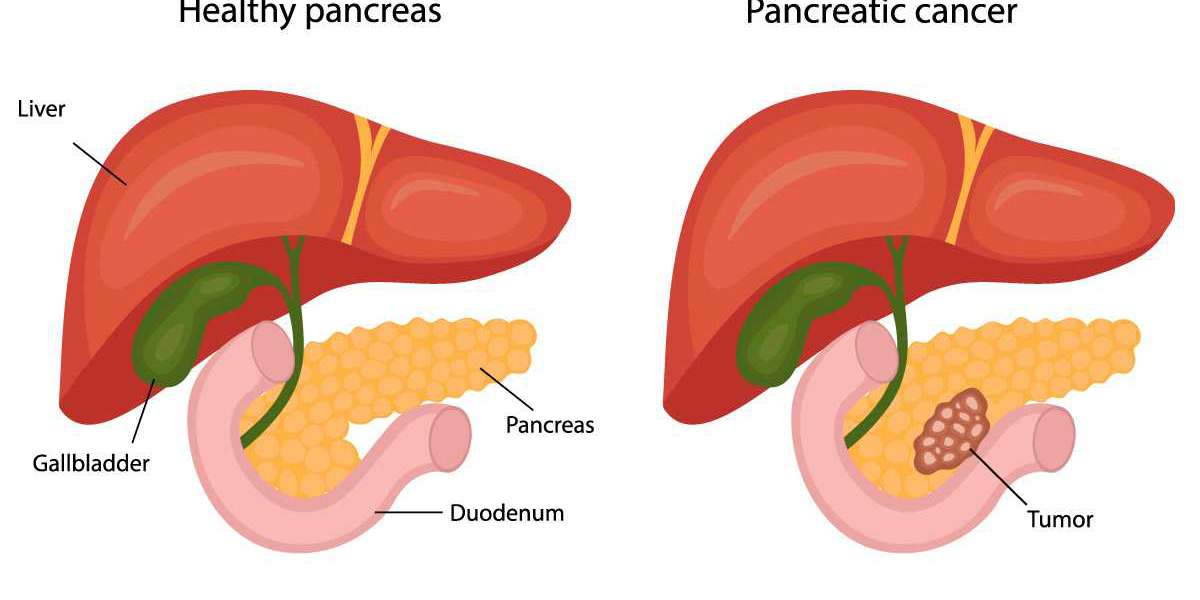 Demystifying the Fatal Consequences of Pancreatic Cancer