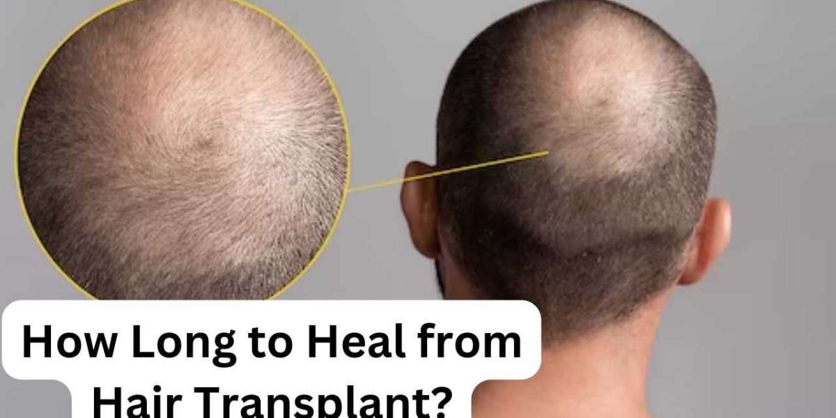 How Long to Heal from Hair Transplant?