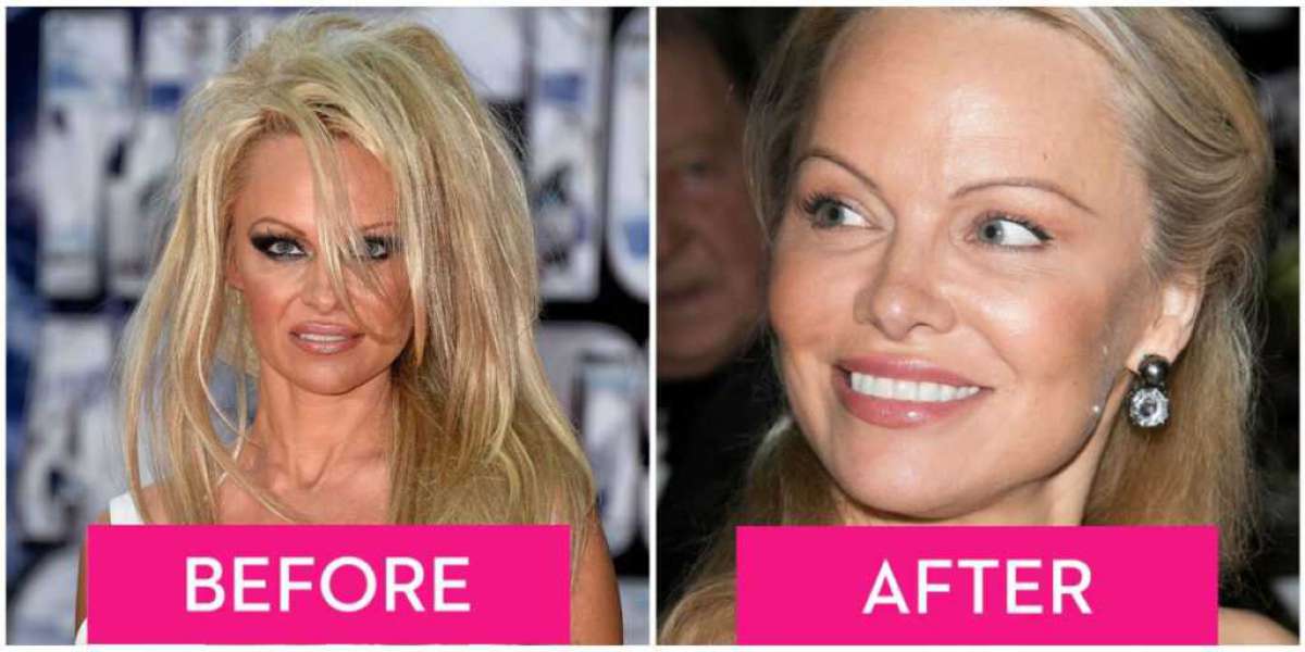 Before and Now Unrecognizable Pam Anderson Now: The Astonishing Transformation