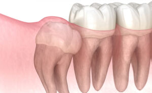Wisdom Teeth Dentist - Brite Smile Dental