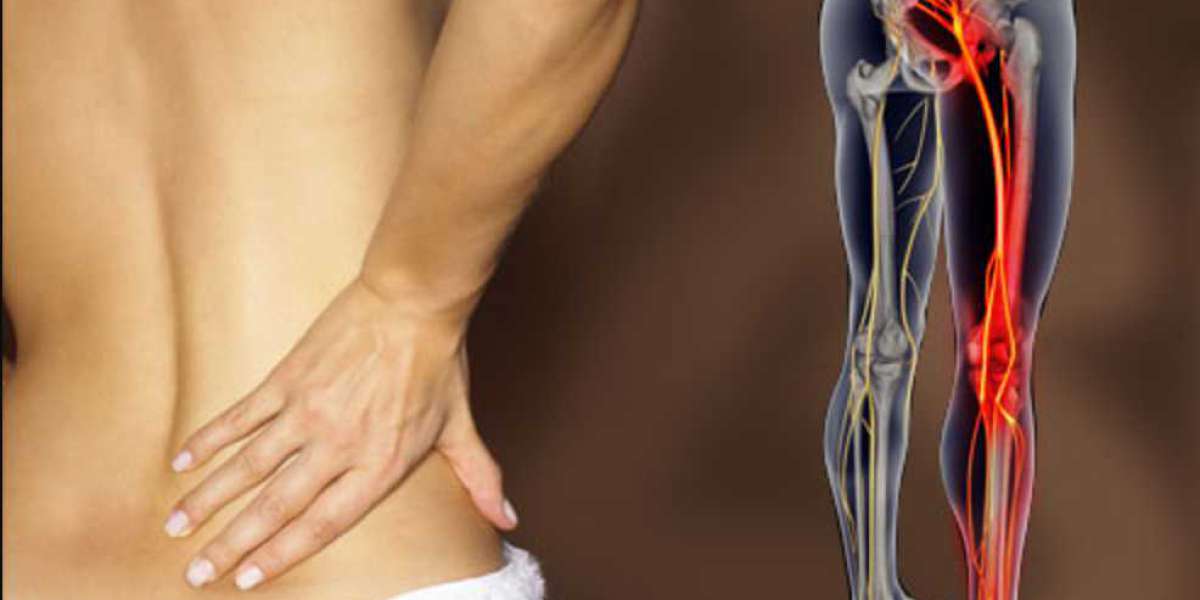 Sciatica: Symptoms, Causes, and Effective Treatment Options
