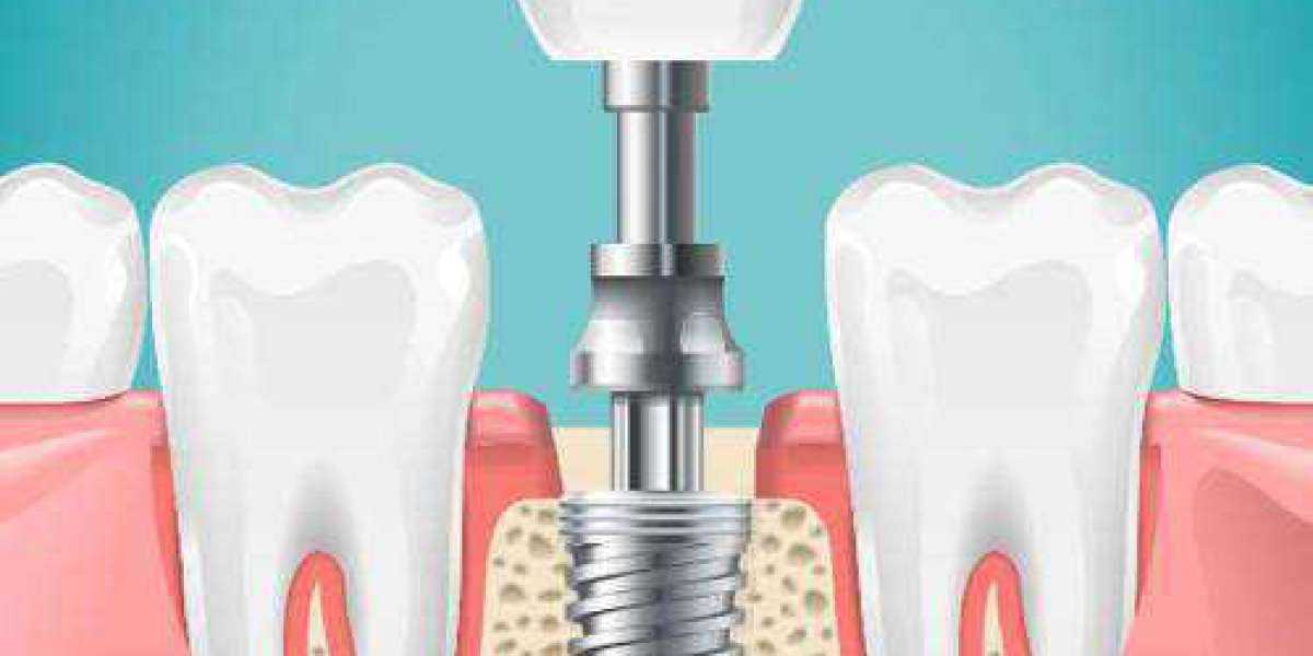 Discover Excellence: Ease Dental, Your Premier Destination for Dental Implants Near Me.