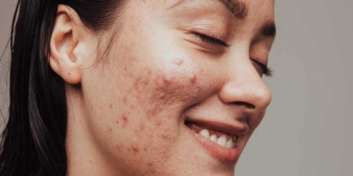 Quick and Long-Term Solutions For Hormonal Acne with Skincare