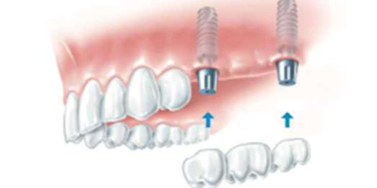 Dental Implant California