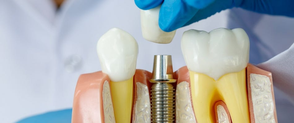 Topnotch things to notice about best dental implants forever | by Hawthorneast | Apr, 2024 | Medium