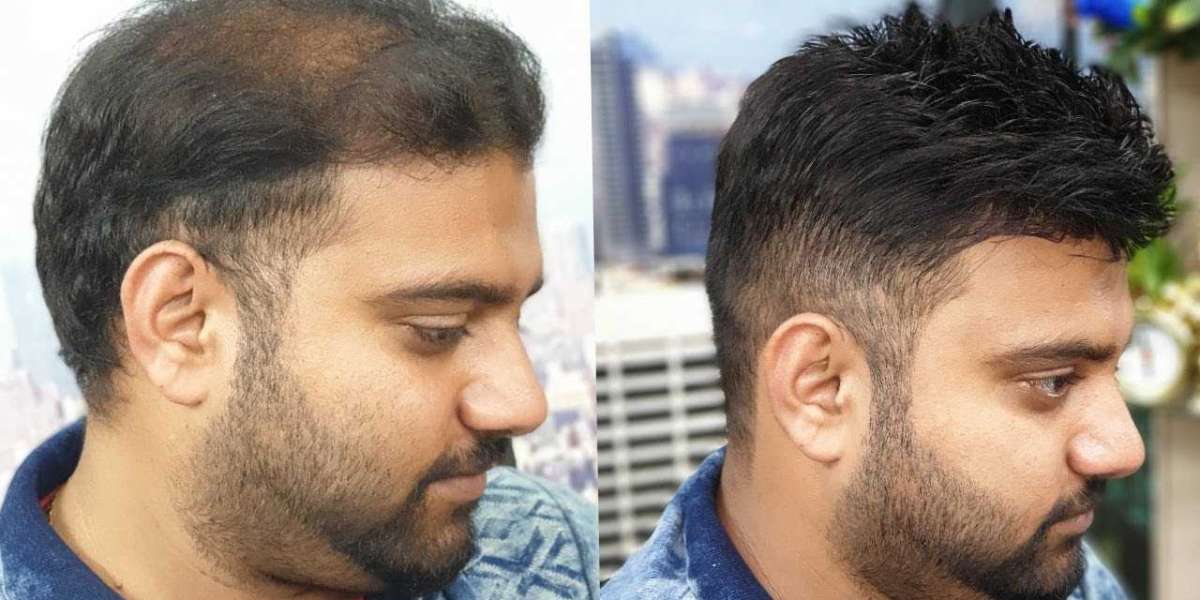 Infinite Strands: Unveiling the Artistry of Hair Transplants in Islamabad