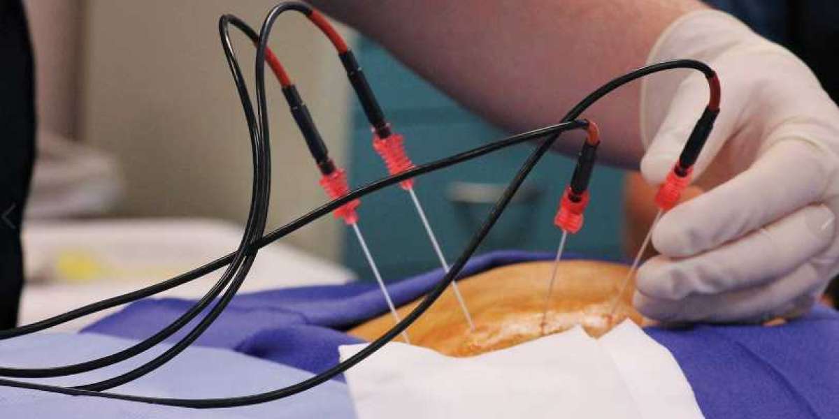 Ablation Technology market Analysis, Size, Share, Trends, Growth and Forecast 2031
