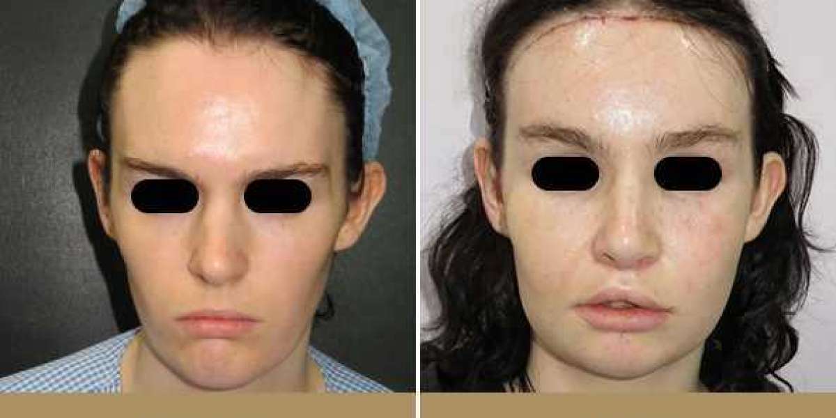 How can facial feminization surgery make you look more feminine?