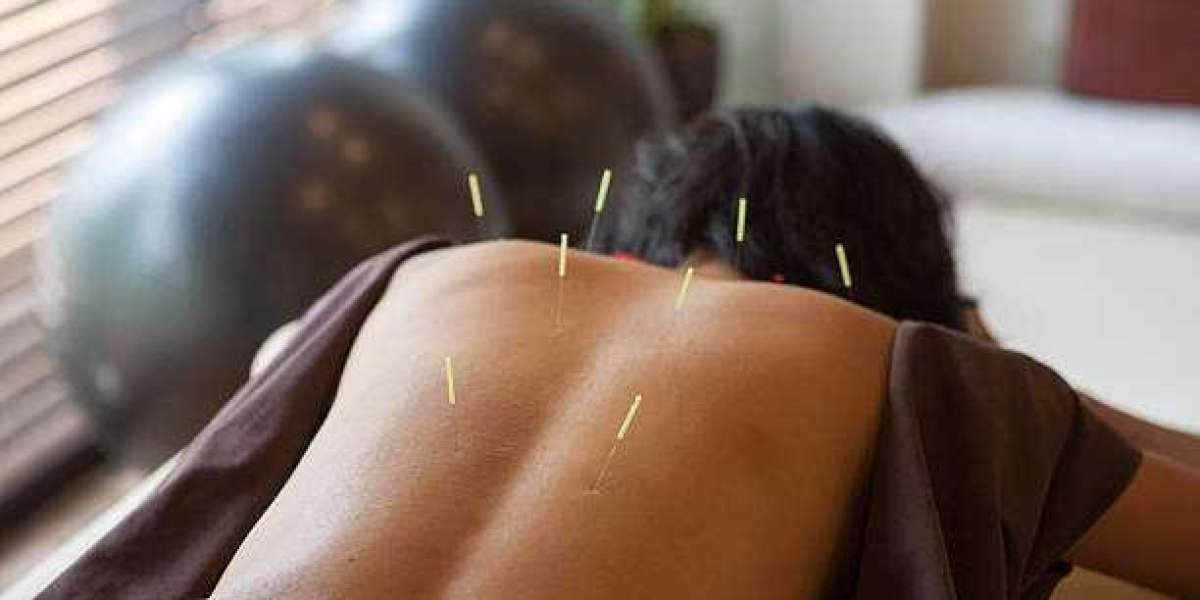 How Acupuncture for Weight Loss Can Transform Your Health