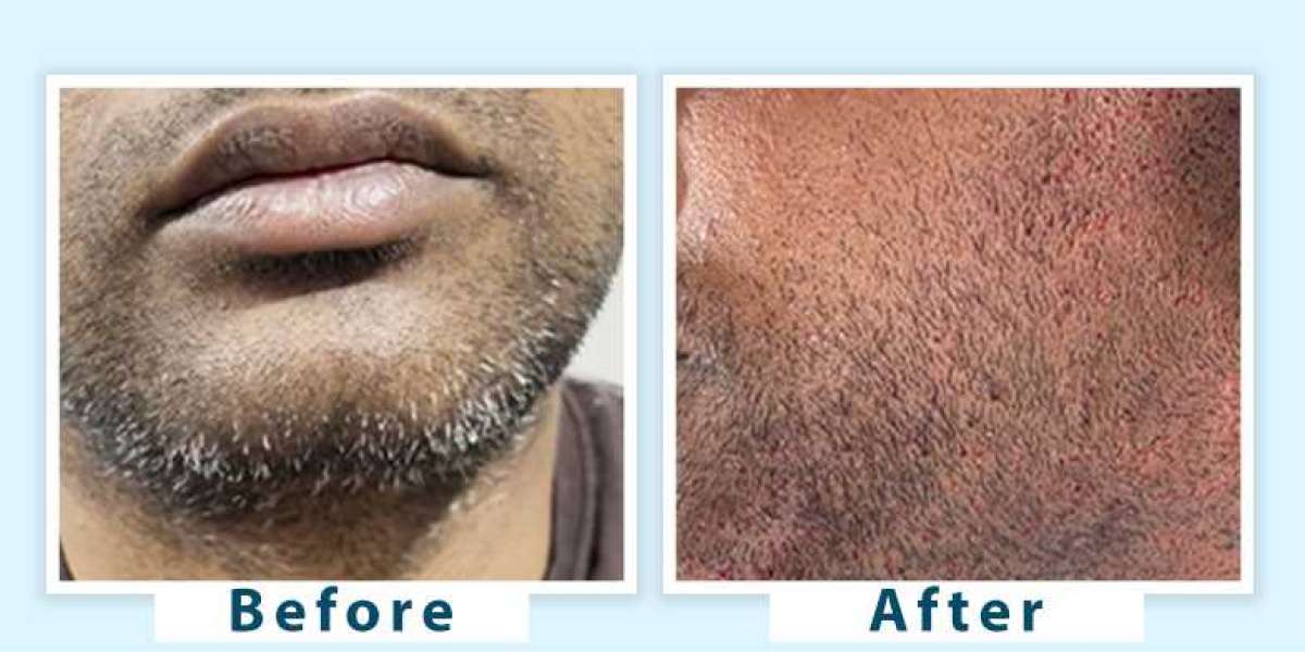 Grey Beard Treatment at AWISH Clinic | Restore Youthful Look