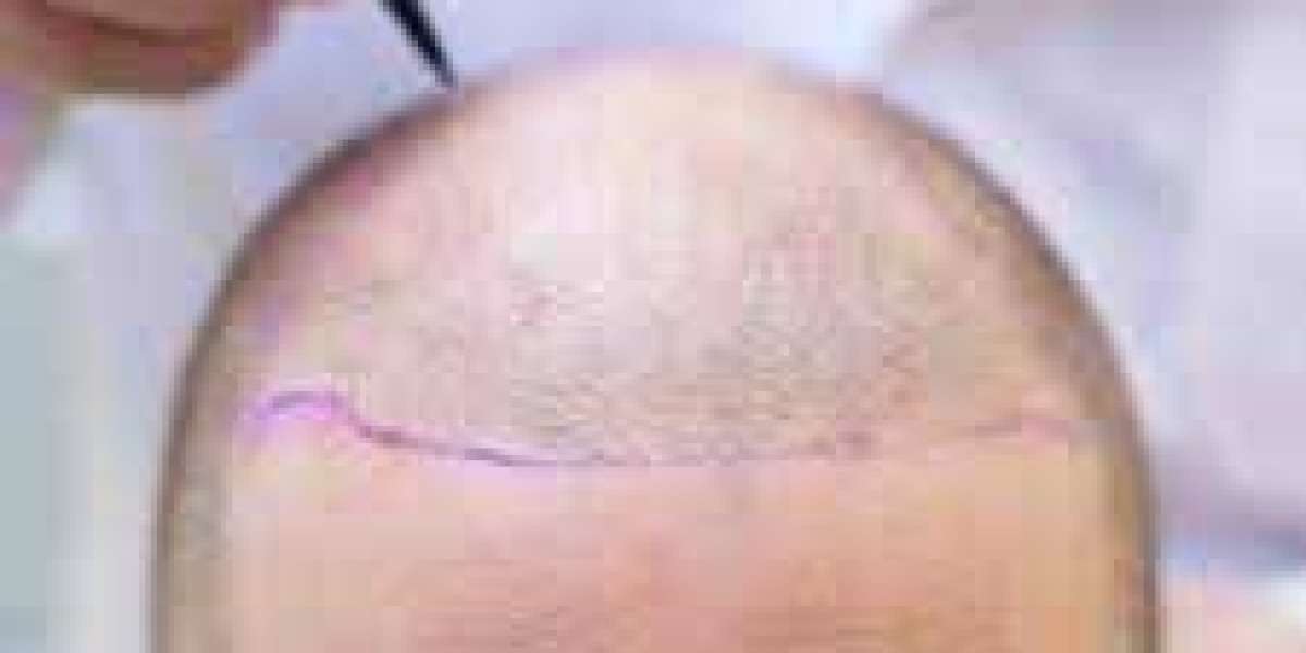 What Can You Expect 30 Days After a Hair Transplant?