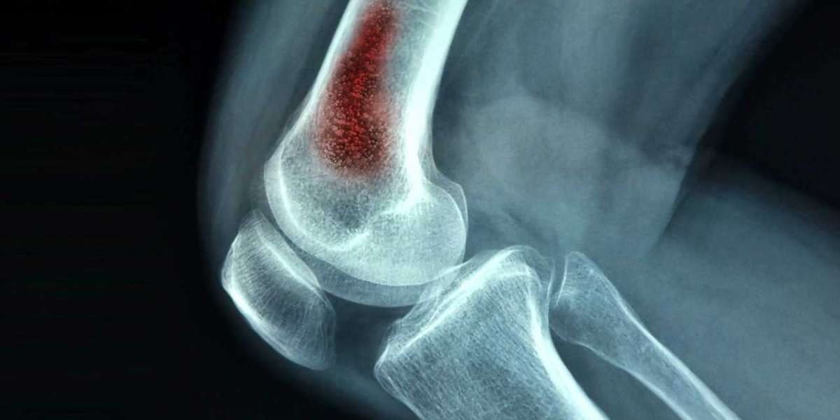 Osteomyelitis Market Research | 2024-2034