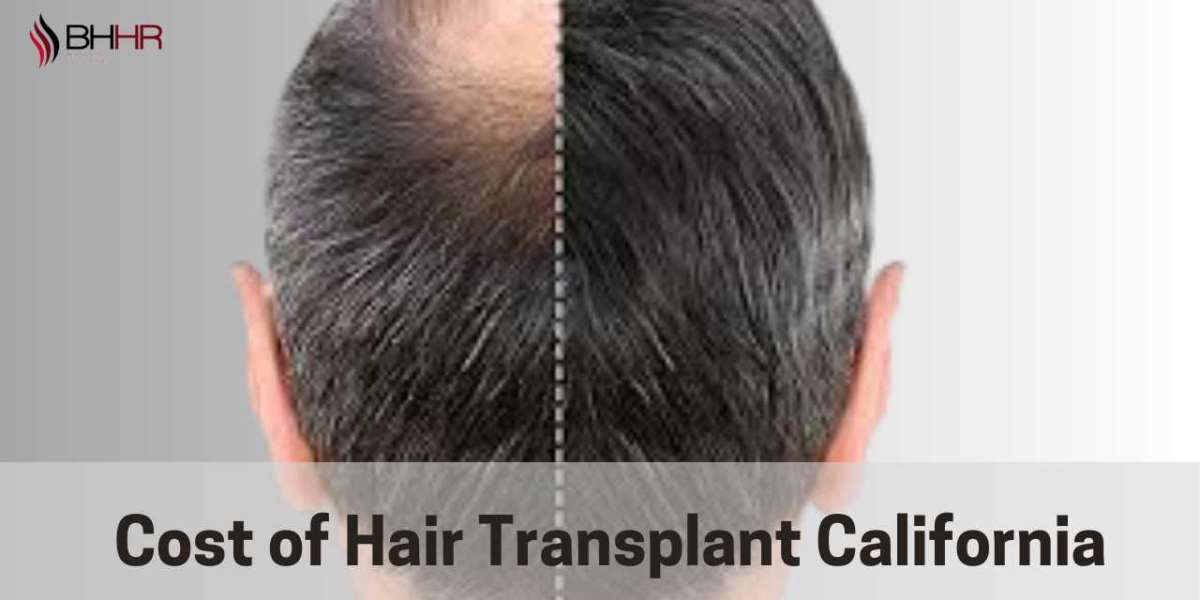 Breaking Down Hair Transplant Costs in California