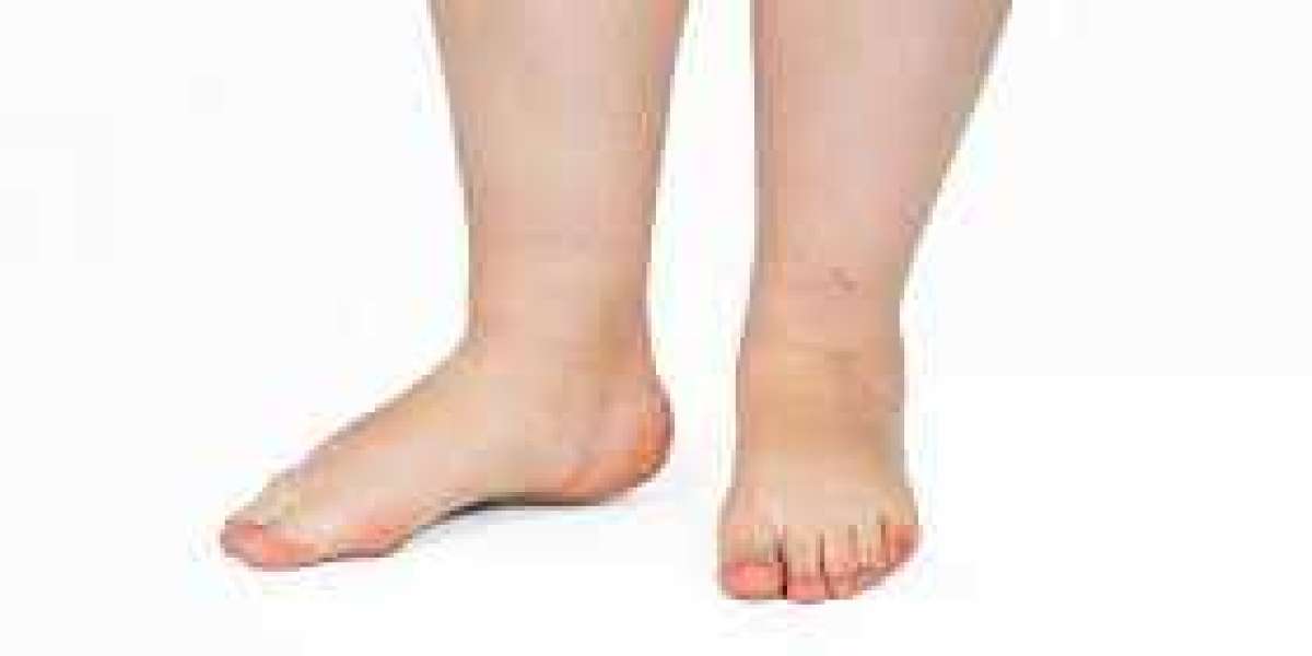 Lymphedema Market Growth, Forecast to 2033