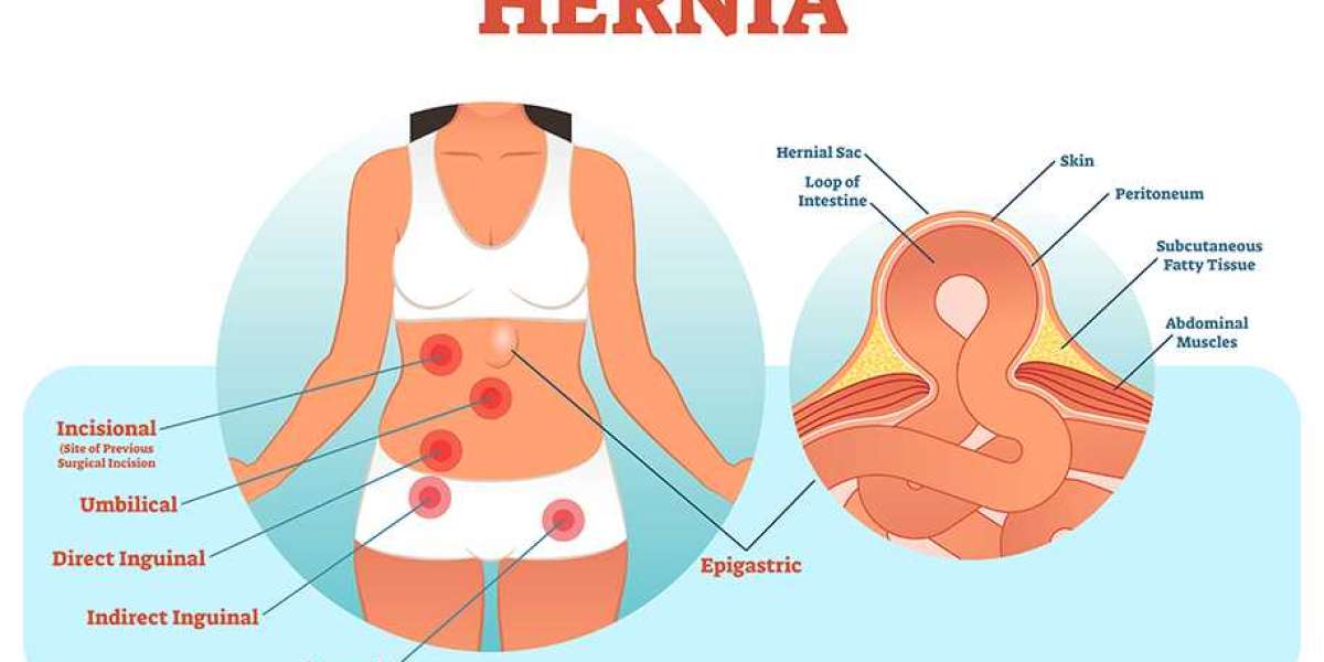 Hernia Surgery Recovery: What You Need to Know