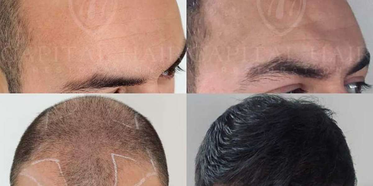 Real Patient Hair Transplant Reviews: The Inside Scoop on Results and Care