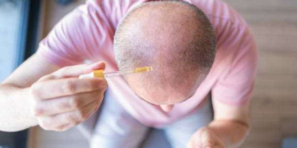 Effective Hair Loss Treatments: A Comprehensive Guide