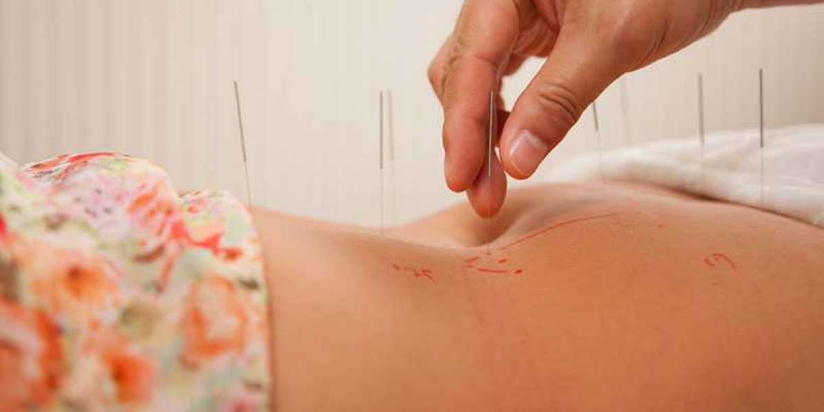 Experience Relief: How Back Pain Acupuncture Can Change Your Life