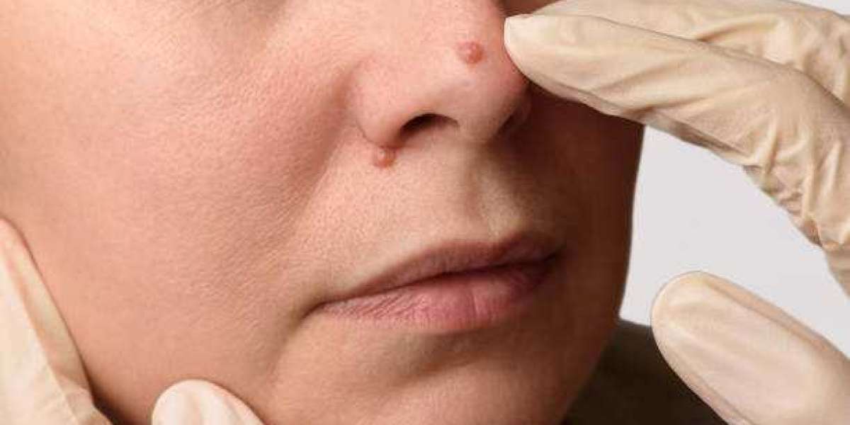 Flawless Skin Ahead: Effective Wart, Skin Tag, and Mole Removal Solutions