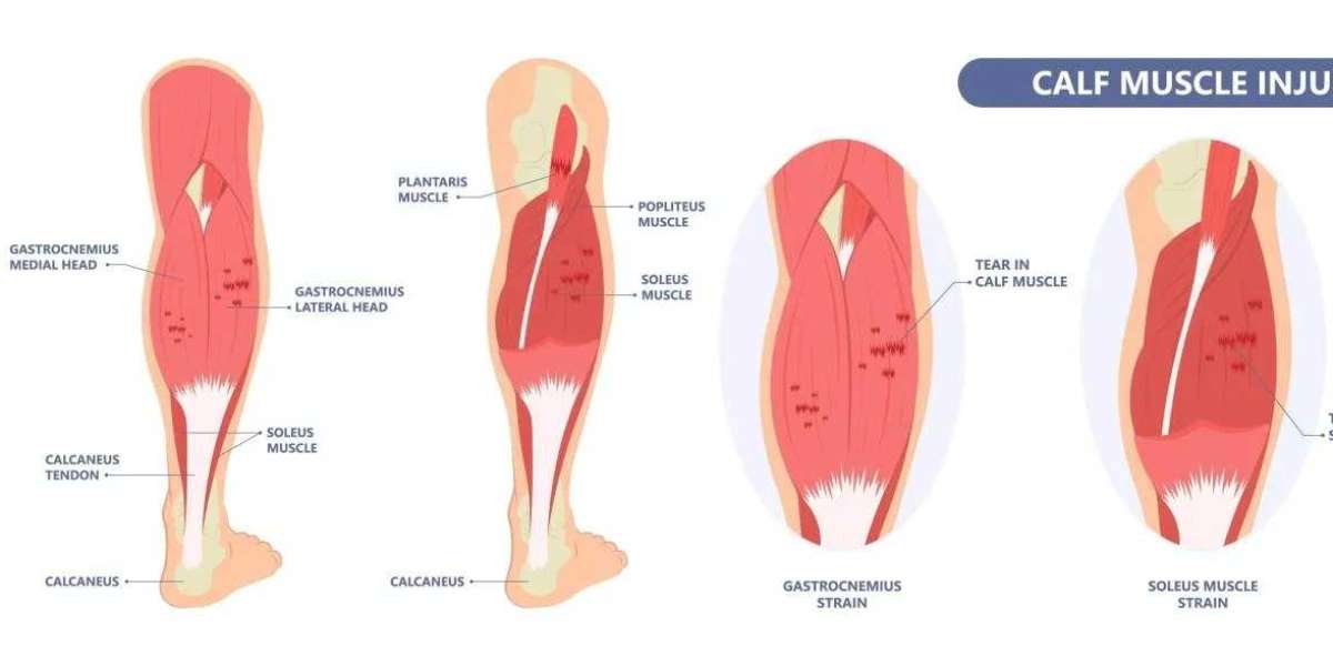 Healing Muscle Injuries: Progressive Specialists’ Complete Guide to Treatment and Prevention