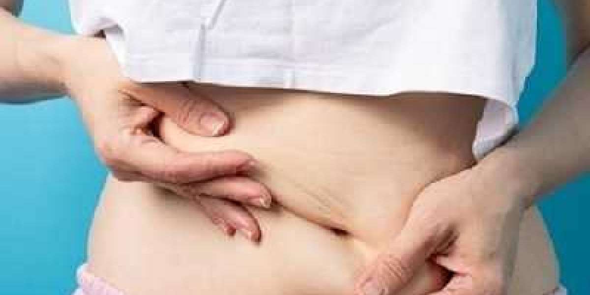 How Much Weight Can Be Removed with Liposuction in Islamabad?